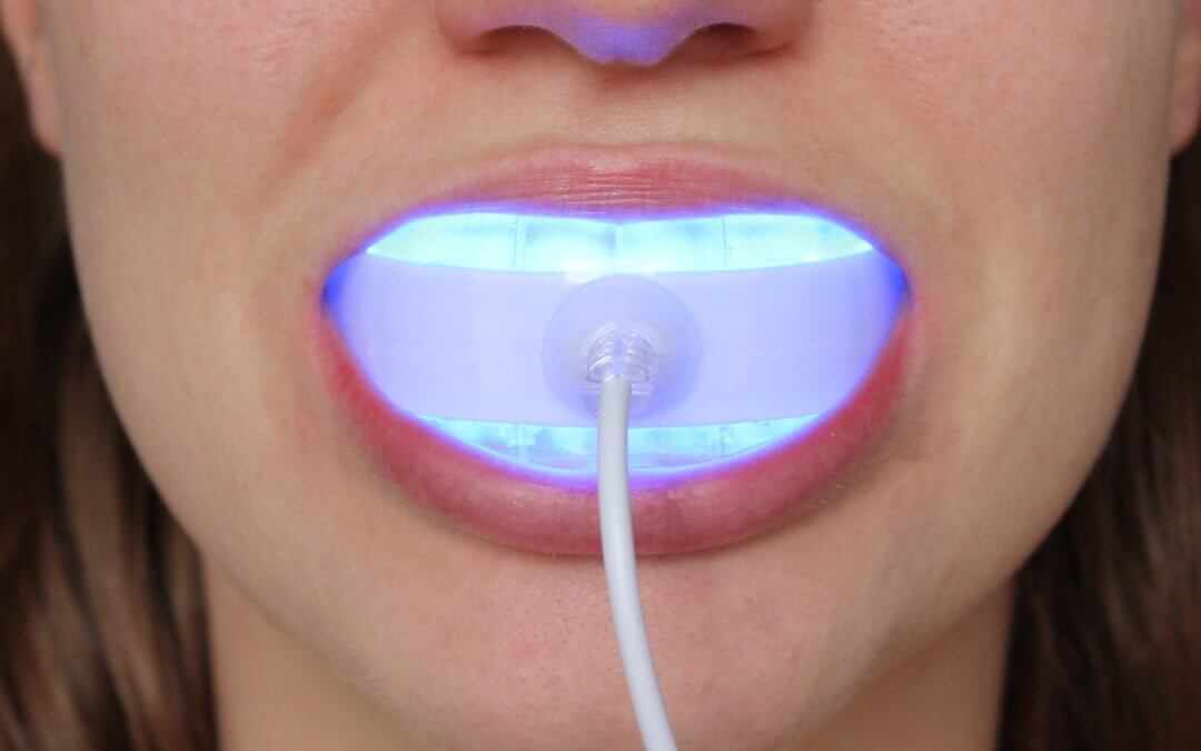 Kit de blanchiment dentaire filaire Hawhite™